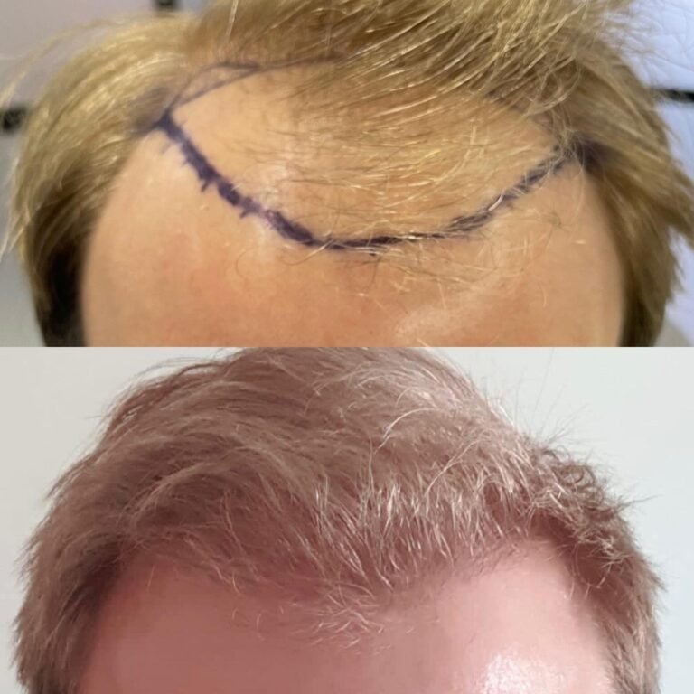 best hair transplant