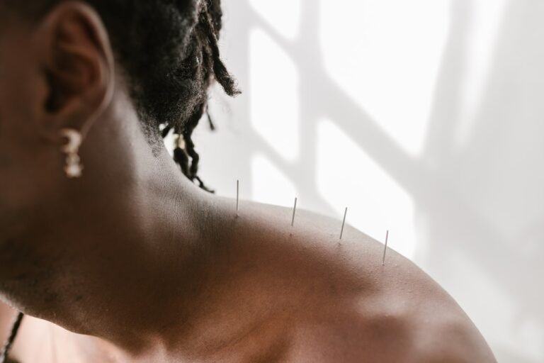 Acupuncture – What It Is And What Are Its Benefits