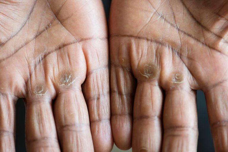 How to Avoid Warts and Their Spread